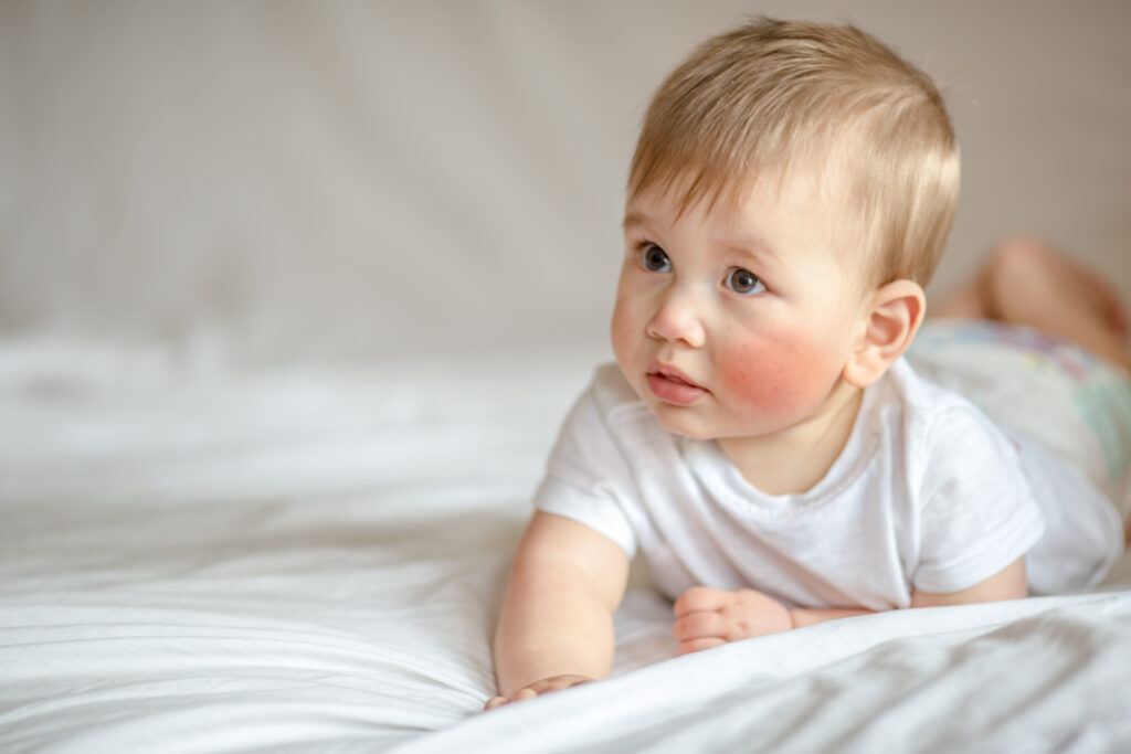 Neurodermitis bei Babys und Kindern