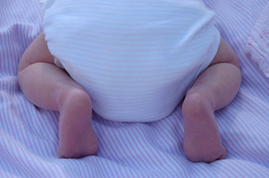 Wenn der Babypopo wund ist: Windeldermatitis oder Windelsoor?