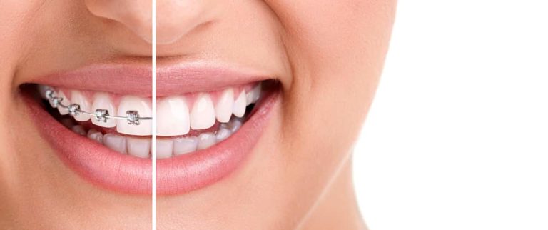 Warum macht eine Zahnzusatzversicherung für Kinder Sinn?