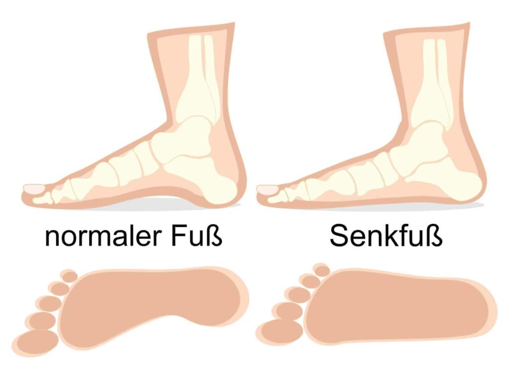 Senkfuß und normaler Fuß