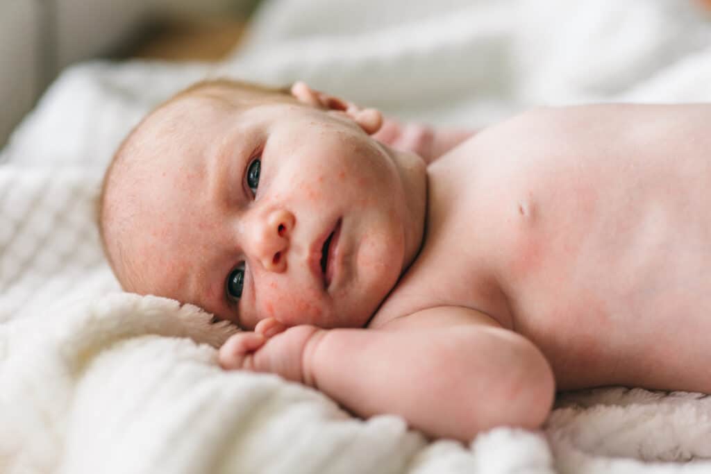 Foto von Baby mit Babyakne.