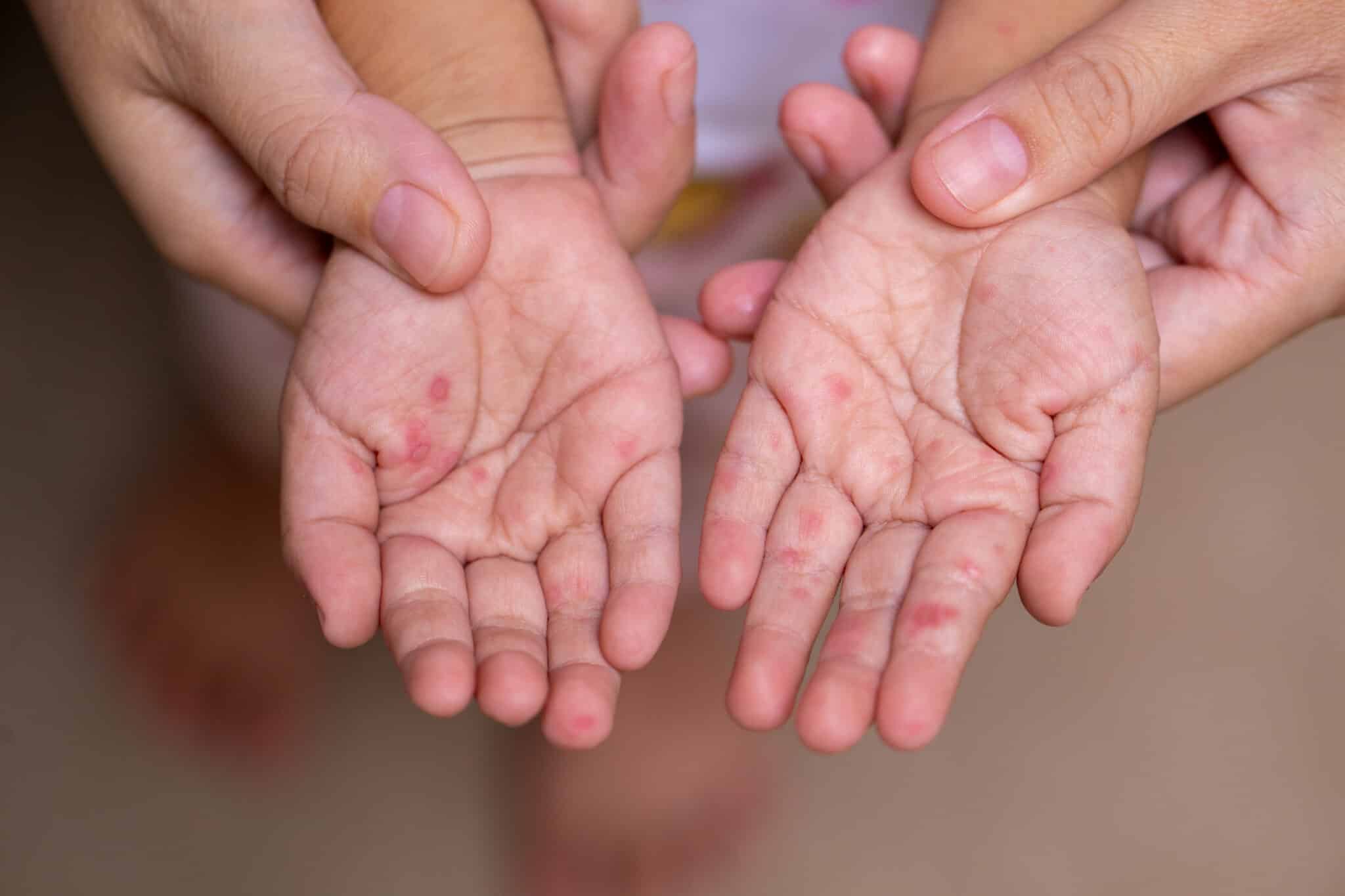 Hand Fuß Mund Krankheit Von Der Infektion Bis Zur Behandlung