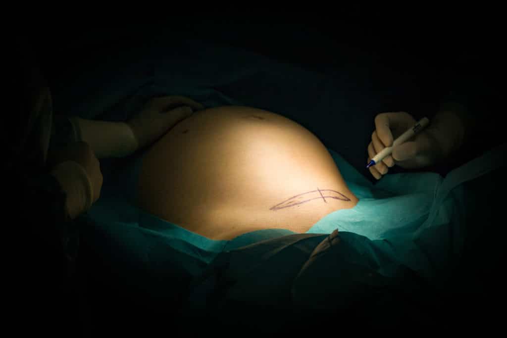 Frau liegt auf OP-Tisch. Vorbereitungen für einen Kaiserschnitt.