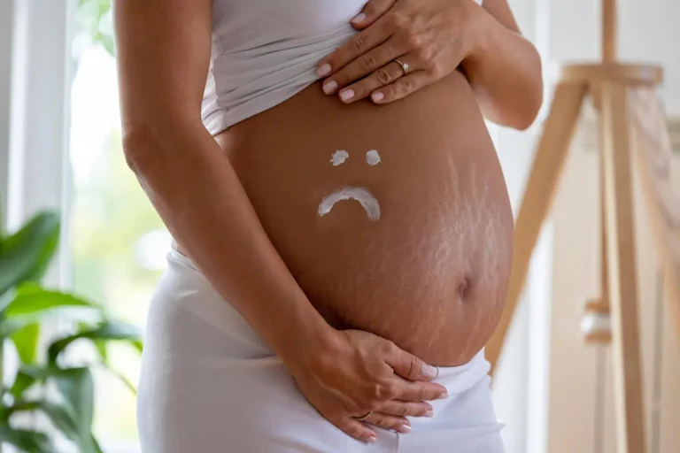 Dehnungsstreifen in der Schwangerschaft – wie kann man vorbeugen?