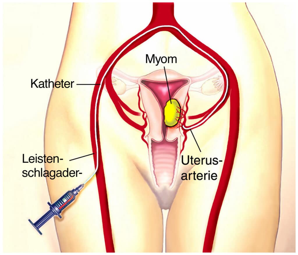 Myome aushungern: Uterine Arterienembolisation.