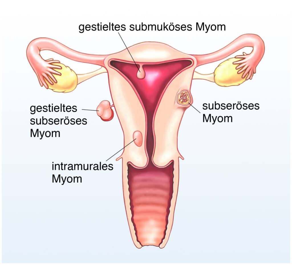 Grafik: Übersicht unterschiedliche Myome in der Gebärmutter