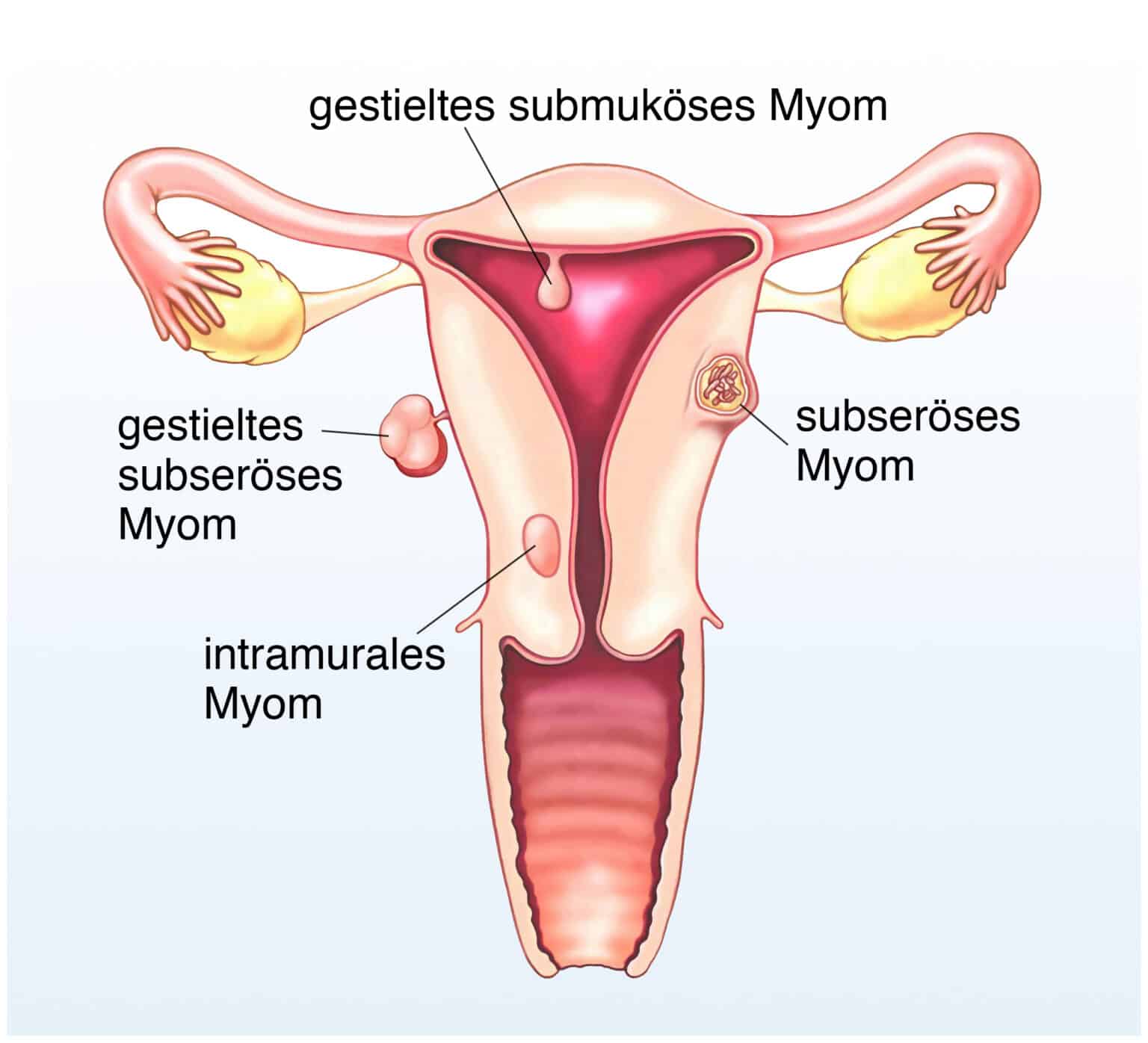Mögliche Symptome für Myome in der Gebärmutter