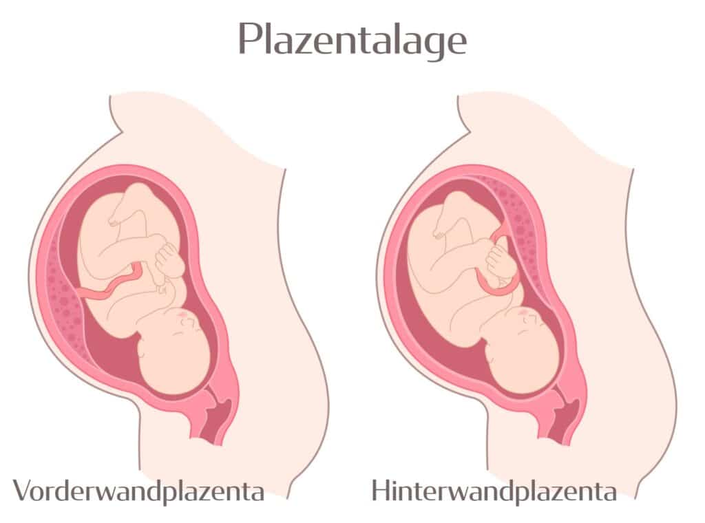 Ansicht Vorderwandplazenta gegen Hinterwandplazenta