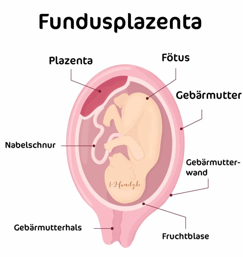 Fundusplazenta: schematische Erklärung in deutscher Sprache. DIeses Bild zeigt die Position der Fundusplazenta in der Gebärmutter.
