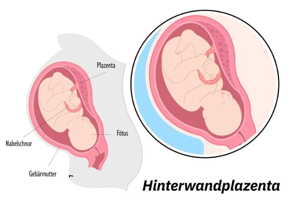 Hinterwandplazenta schematische Erklärzeichnung