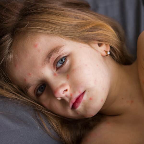 Aktuelle Infos zu Masern