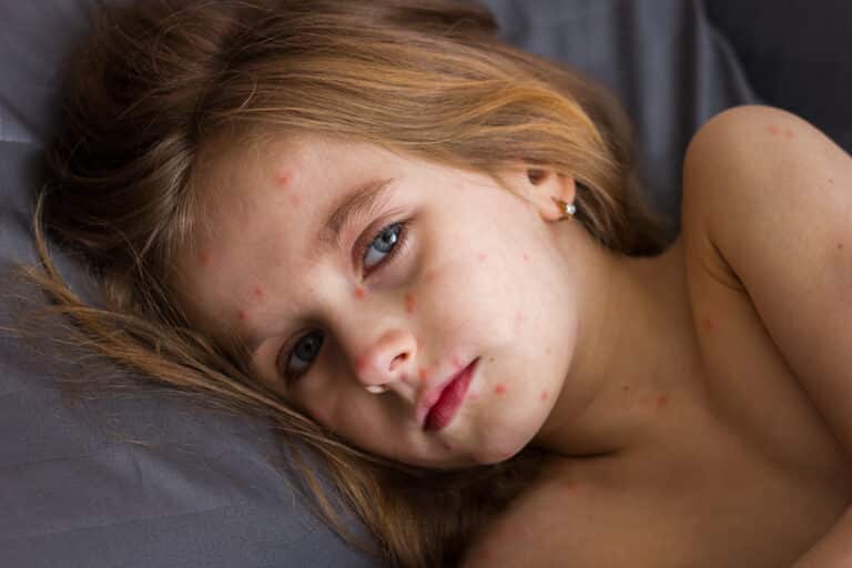 Aktuelle Infos zu Masern