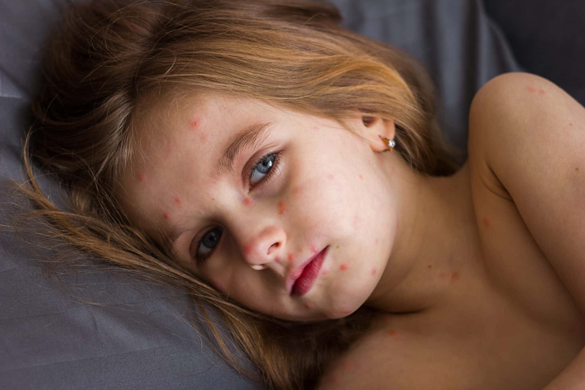 Aktuelle Infos zu Masern