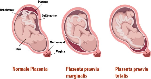 Schaubild Plazenta Praevia: Hier seht ihr die unterschiedlichen Ausprägungen leicht verständlich dargestellt.